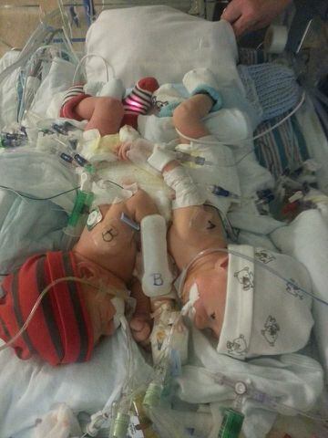 Conjoined twins born in Jacksonville