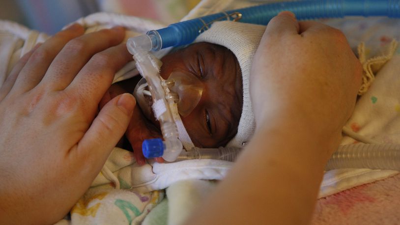 FILE — A 15-day-old baby who was born prematurely at an orphanage in Petionville, Haiti, on June 15, 2010. Premature births, after years of steady decline, rose sharply in the U.S. between 2014 and 2022, according to recently published data from the Centers for Disease Control and Prevention. (Ruth Fremson/The New York Times)