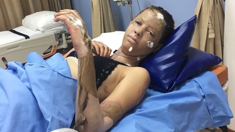Abigail Alexander is being treated in a hospital after she and a British teacher were victims in the blast that injured 13 people in Cambodia last wek, according to multiple reports. CONTRIBUTED