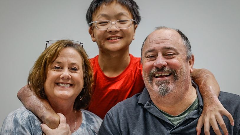Julian and Angie Farley, from Washington Township near Centerville, are adopting Xin Liang from China. Liang's Chinese parents believe Xin would have a better life in the United States after Xin was severely burned in his village. JIM NOELKER/STAFF