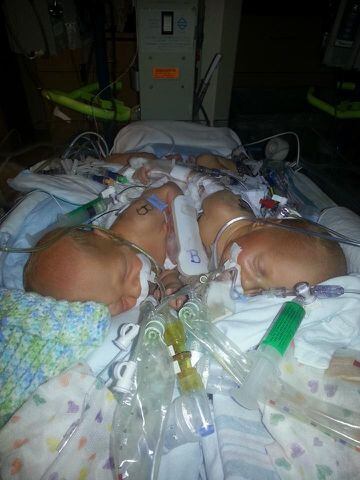 Conjoined twins born in Jacksonville
