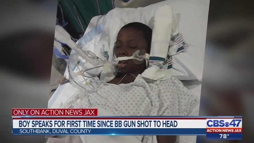 Elijah Hill is recovering after he was shot by a BB gun.
