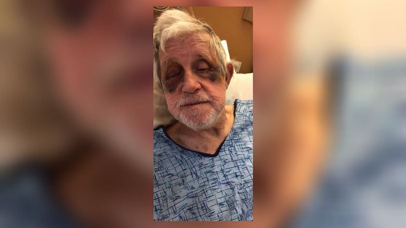 Photos provided by John D. Sexton’s family show the bruising on his face from a Jan. 25 incident at Wood Glen Alzheimer’s Community in Miami Twp.