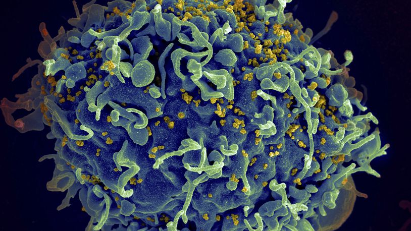 FILE - This electron microscope image made available by the U.S. National Institutes of Health shows a human T cell, in blue, under attack by HIV, in yellow, the virus that causes AIDS. Three women who were diagnosed with HIV after getting “vampire facial” procedures at an unlicensed New Mexico medical spa are the first believed to have contracted the virus through a cosmetic procedure using needles, according to federal health officials. (Seth Pincus, Elizabeth Fischer, Austin Athman/National Institute of Allergy and Infectious Diseases/NIH via AP, File)