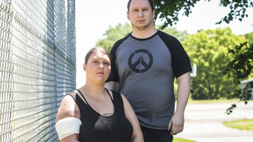 Tiffany and Zach Guithues from Dayton were struck by gun-fired bean bags during a protest Saturday on Keowee Street in Dayton. Tiffany said she had a bag removed from her arm at the hospital. JIM NOELKER/STAFF