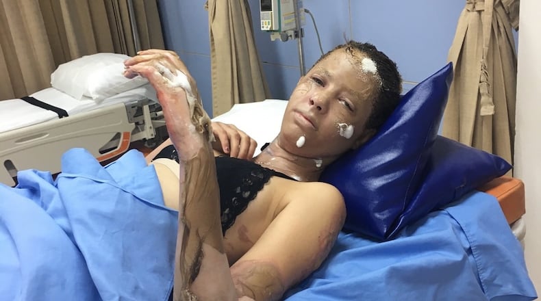 Abigail Alexander is being treated in a hospital after she and a British teacher were victims in the blast that injured 13 people in Cambodia last wek, according to multiple reports. CONTRIBUTED