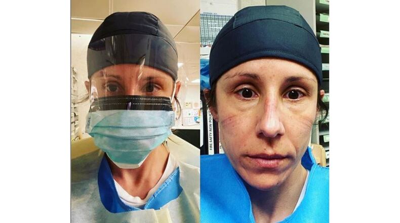 Clayton registered nurse Staci Hedke began a three week stint to help fight the coronavirus in New York.  Hedke is pictured after her first 13 hour shift at Metropolitan Hospital.