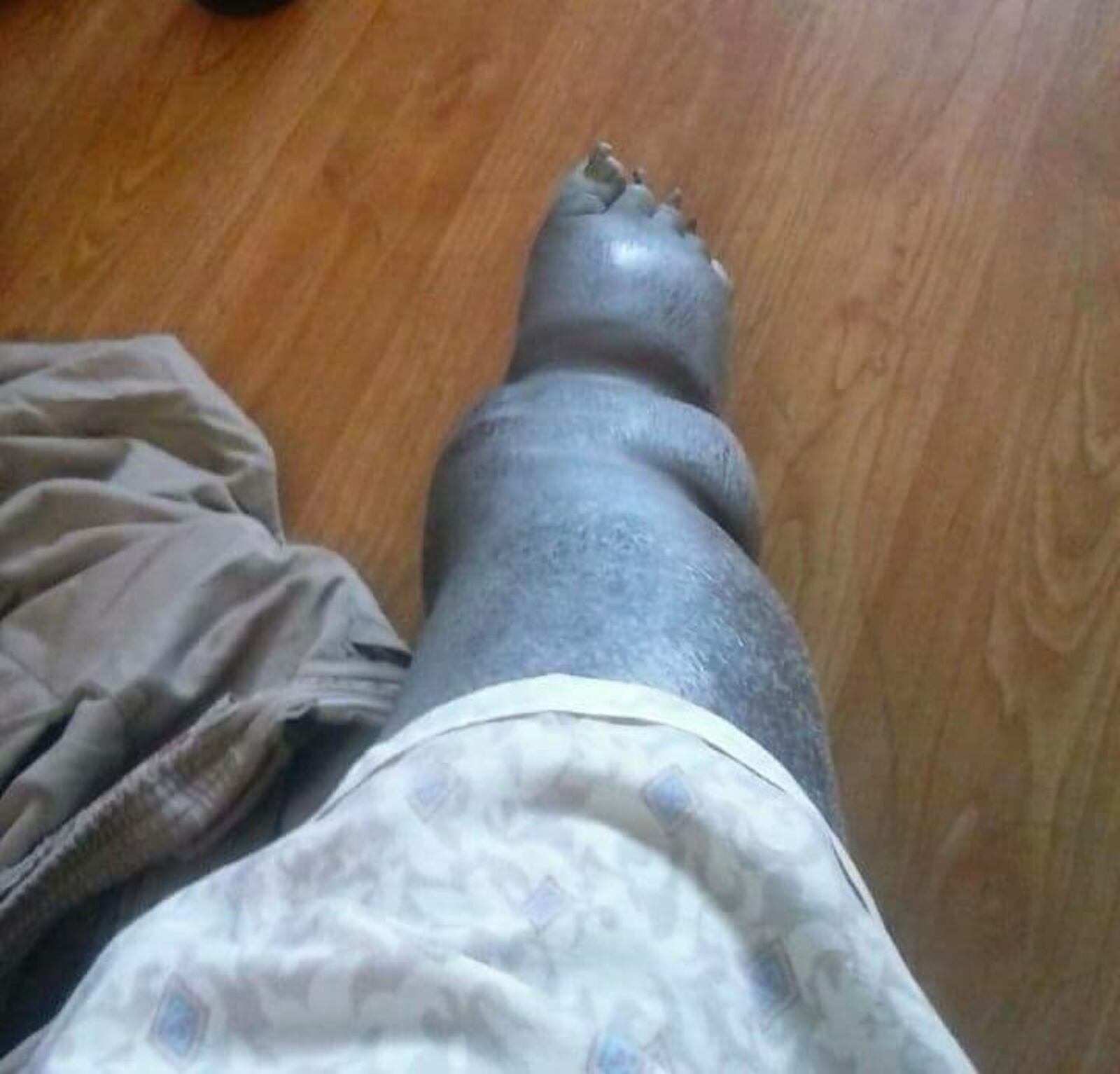 Easley's foot and leg as they appeared before his 280-pound weight loss. Emerson Easley/Contributed