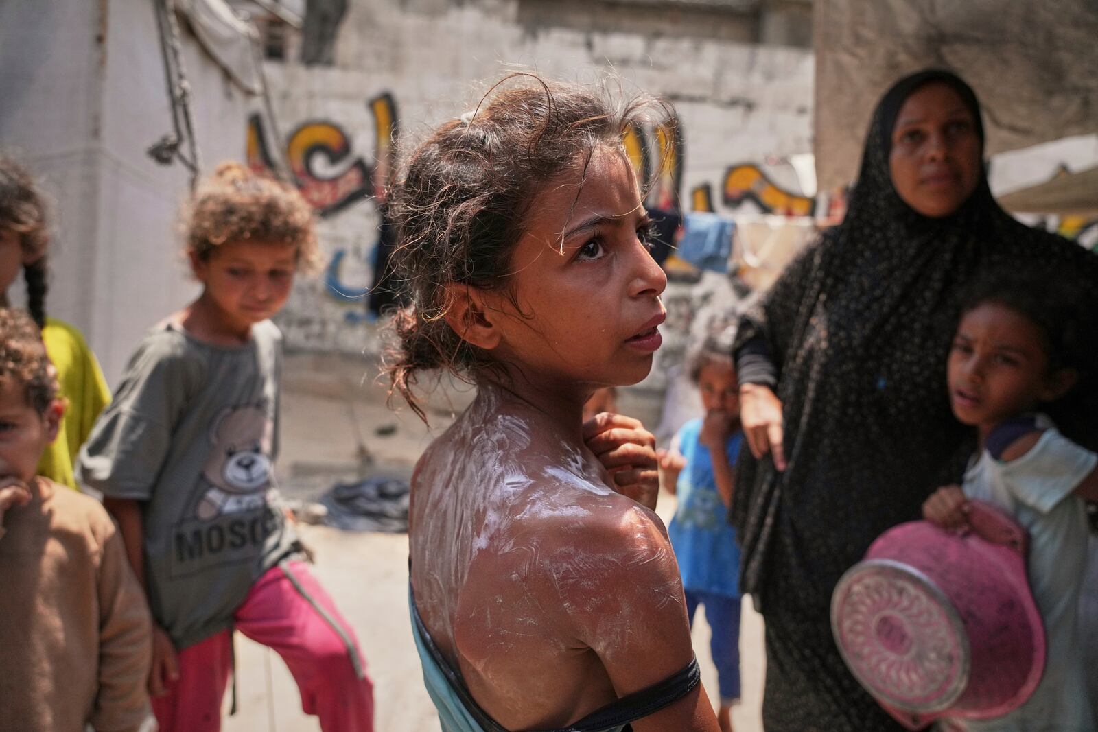 Rital Abu Jari, 9, stands after receiving cream to relieve burns on her back and shoulder, which she suffered while trying to get warm donated food at a community kitchen in Gaza City, Tuesday, June 10, 2025. (AP Photo/Jehad Alshrafi)
