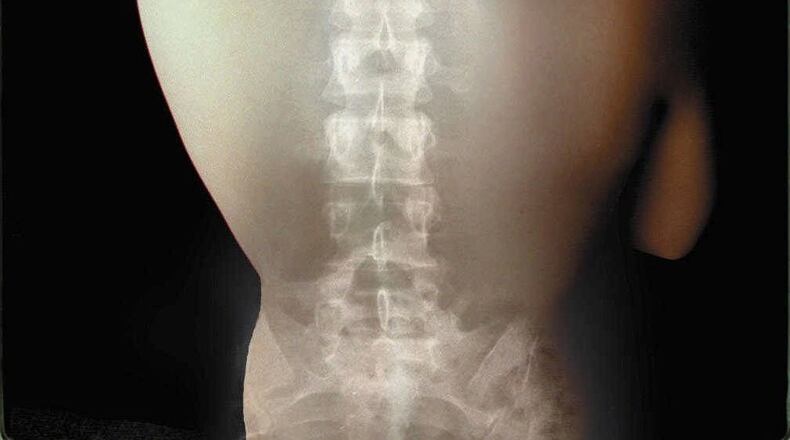 The X-ray of a spine super-imposed on a womanās back illustrates the importance of monitoring and treatment of osteoporosis, a weakening of the bones that affects 25 million Americans. FILE