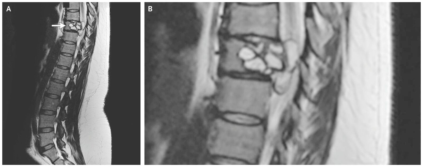 X-ray showing tapeworm in woman's spine.