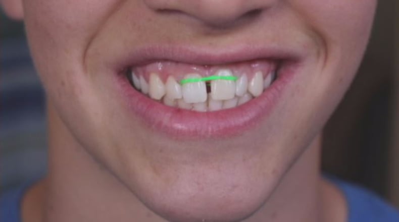 American Association of Orthodontists issues a renewed warning about homemade braces.