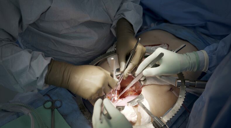 FILE - Surgeons at NYU Langone Health prepare to transplant a pig's kidney into a brain-dead man in New York on July 14, 2023. (AP Photo/Shelby Lum, File)