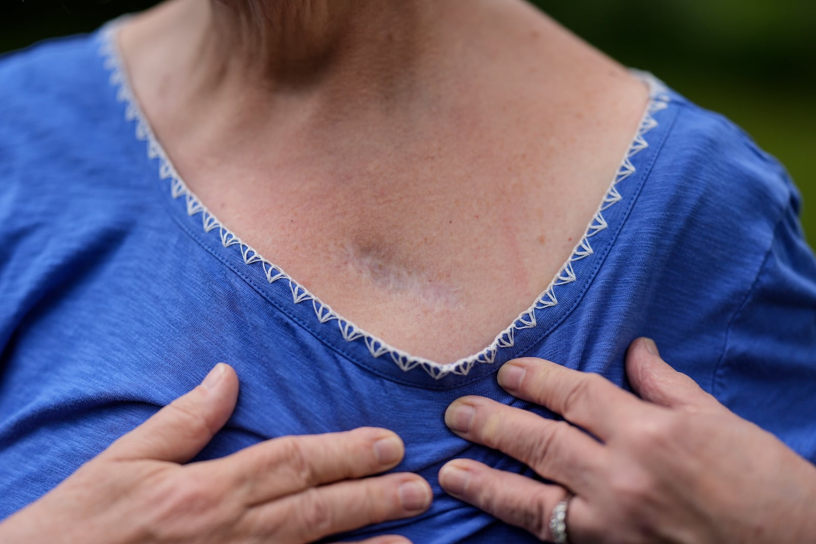 Carol Seegar shows where her deep brain stimulator, powered by an Abbott Brio IPG, was implanted in her body, Thursday, July 24, 2025, in Atlanta. (AP Photo/Mike Stewart)