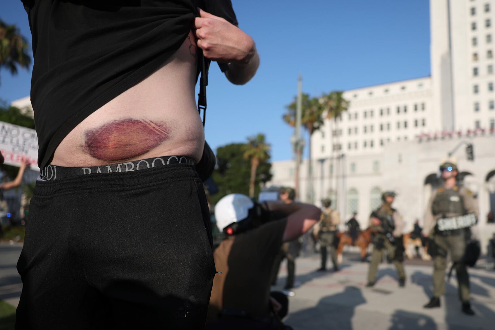 A protester displays their injury from a less-lethal round from several days ago during a protest outside City Hall on Wednesday, June 11, 2025, in Los Angeles. (AP Photo/Ethan Swope)