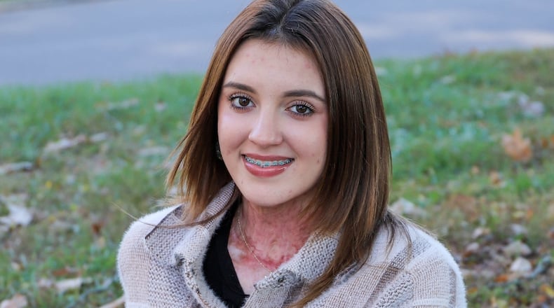 Milli Bennett of Lynchburg, Ohio months after her burn accident in 2024. CONTRIBUTED