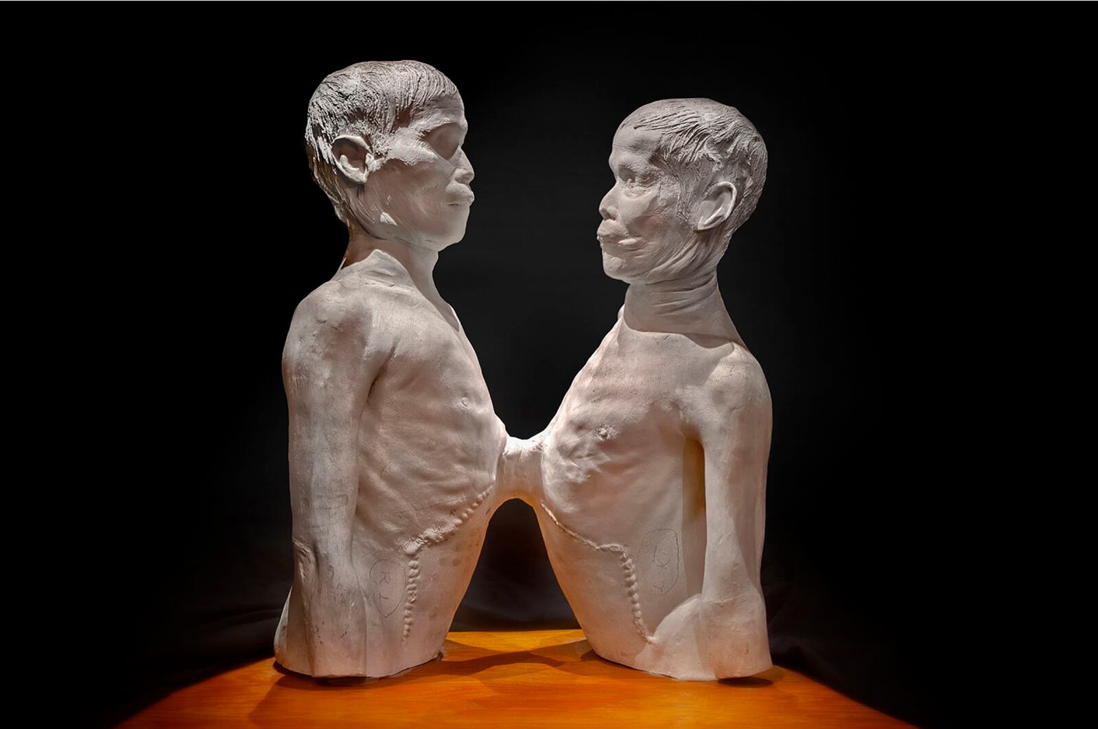 Death Cast of "Siamese Twins" Chang and Eng Bunker at the MÃ¼tter Museum in Philadelphia. PHOTO: MUTTER MUSEUM