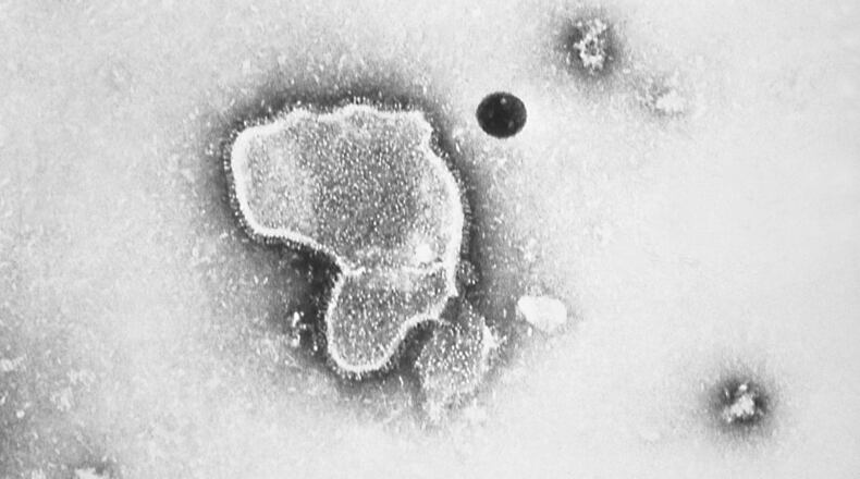 This 1981 photo provided by the Centers for Disease Control and Prevention (CDC) shows an electron micrograph of Respiratory Syncytial Virus, also known as RSV. Children's hospitals in parts of the country are seeing a distressing surge in RSV, a common respiratory illness that can cause severe breathing problems for babies. Cases fell dramatically two years ago as the pandemic shut down schools, day cares and businesses. Then, with restrictions easing, the summer of 2021 brought an alarming increase in what is normally a fall and winter virus. (CDC via AP)