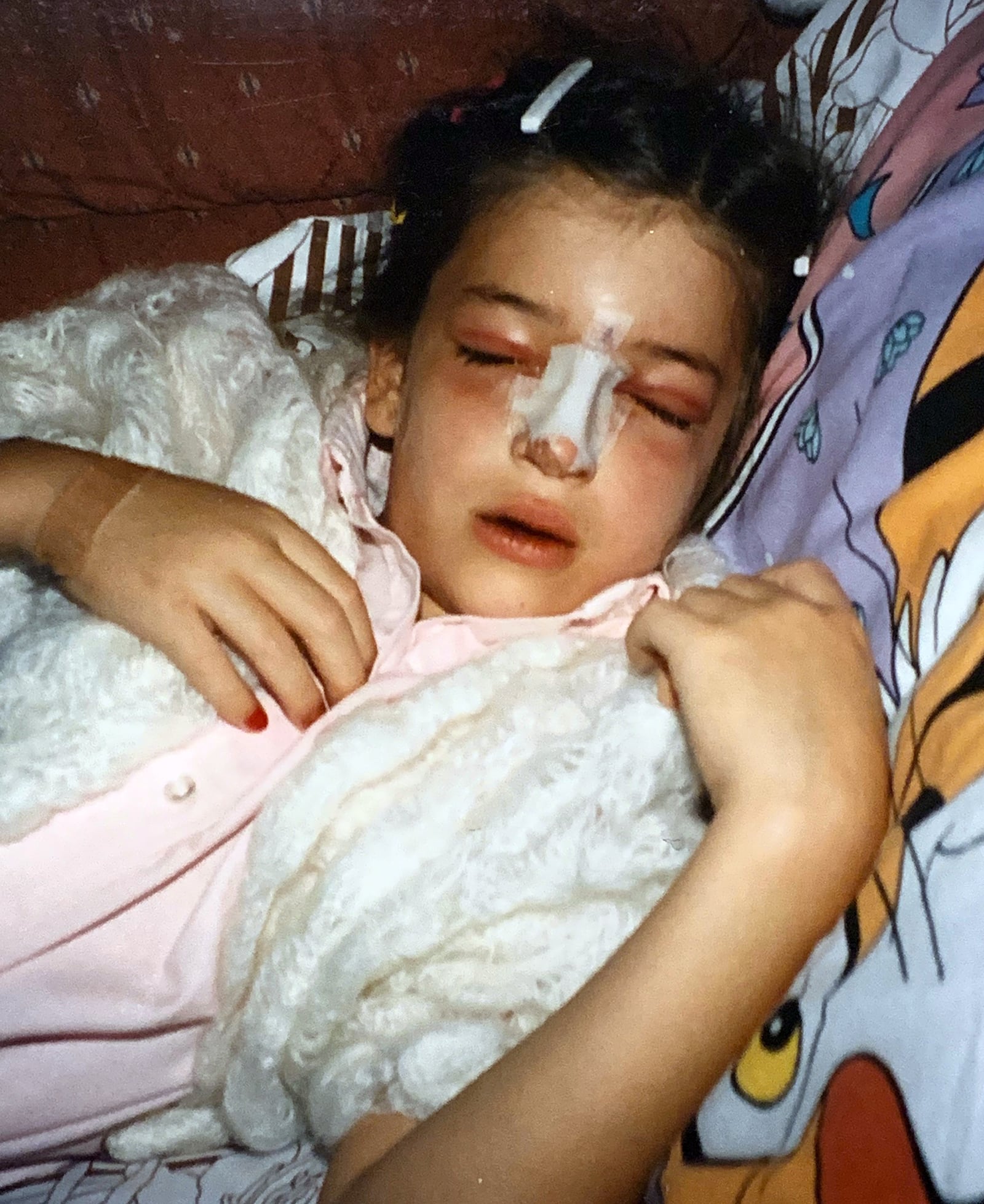 Abigael Kaszar recovering from a surgery to repair her nose after she was involved in a serious accident in 1995 as a first grader. This accident ended up changing her life and helped her decide to be a nurse. CONTRIBUTED