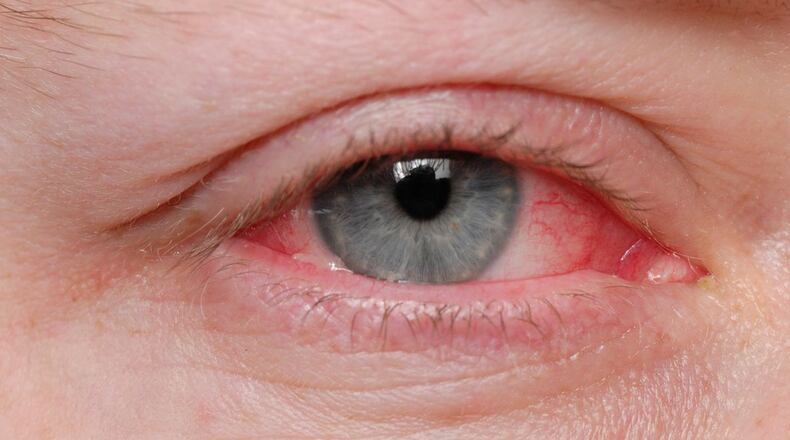 FILE PHOTO: Doctors say pink eye may be a rare symptom of COVID-19.