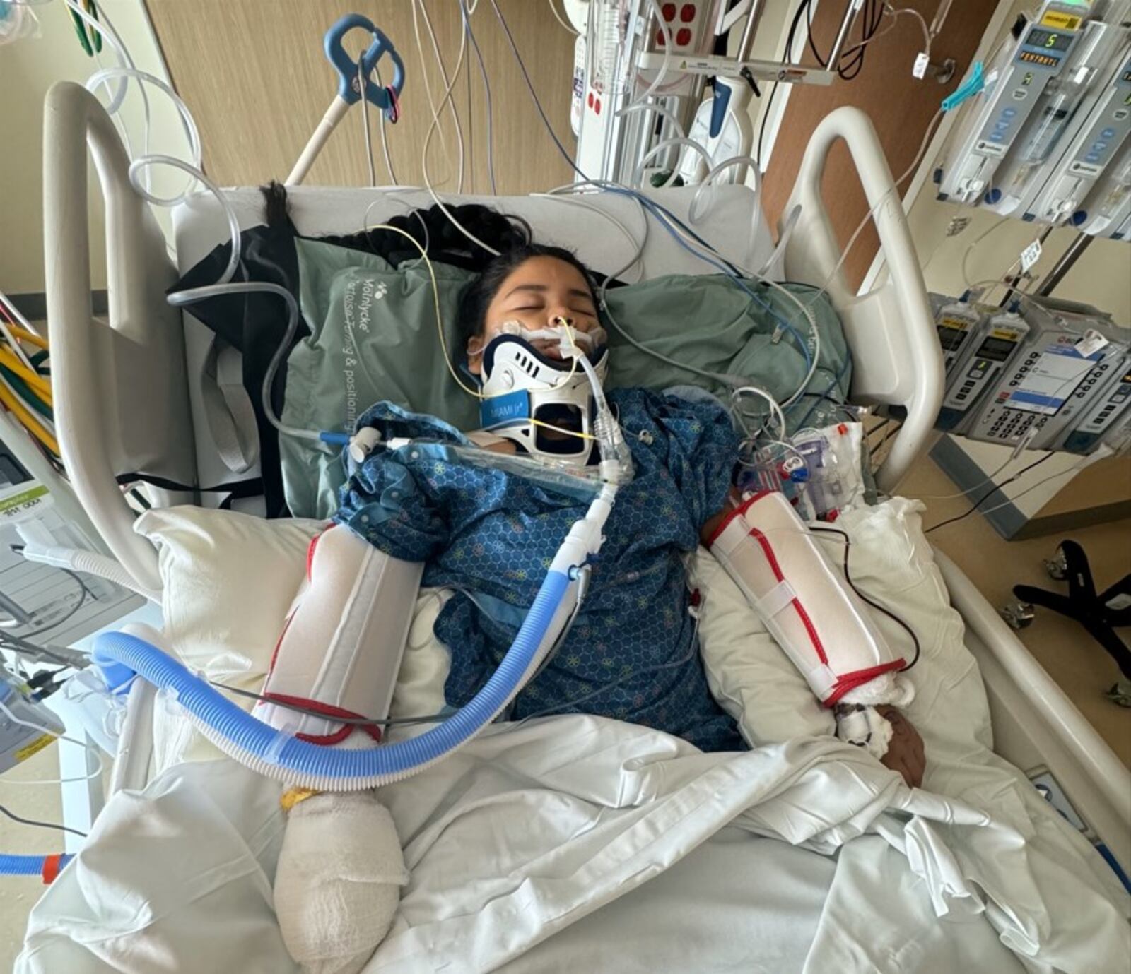 Ashley Escalante, 9, of Dayton, was in a coma for 10 days after she was struck by a hit-and-run driver on July 22, 2024. Her left foot was amputated and she nearly lost her right foot. CONTRIBUTED 